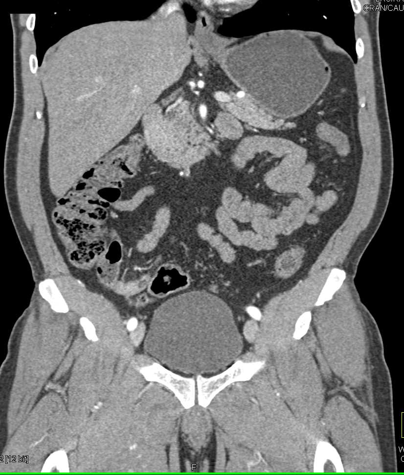 Carcinoma of the Appendix - CTisus CT Scan