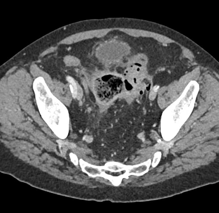Colovesicle Fistulae - CTisus CT Scan