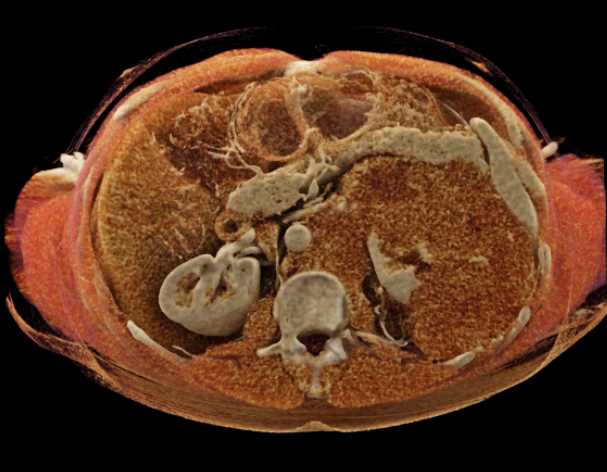 Lymphoma Infiltrates the Left Kidney - CTisus CT Scan
