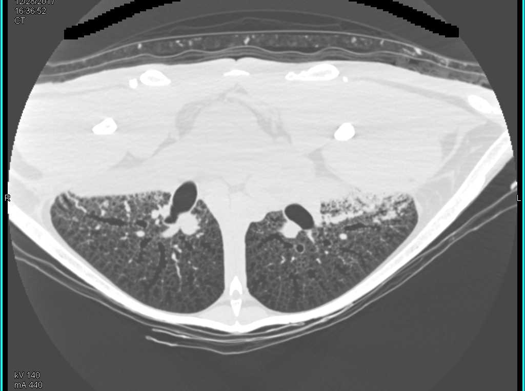 Turtle Lungs with Bronchial Tree - CTisus CT Scan